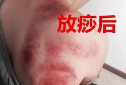 揪痧视频,轻松掌握居家养生新技能